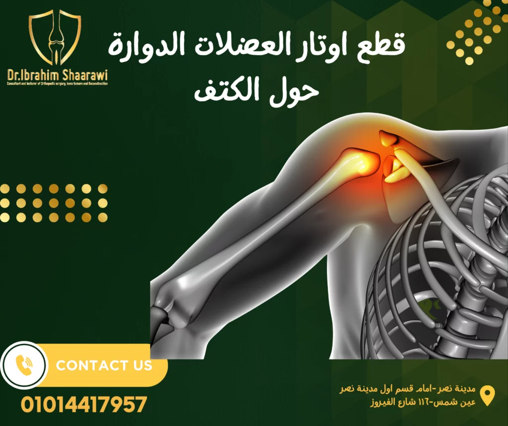 علاج قطع وتر الكتف بدون جراحة علاج قطع وتر الكتف بدون جراحة