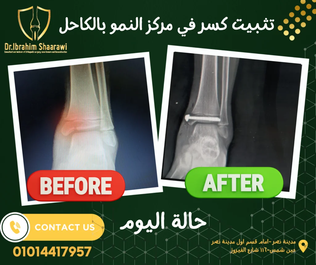 علاج كسر في مركز النمو