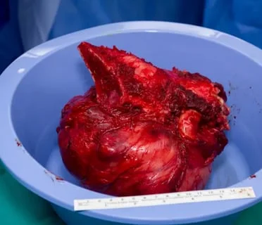 ساركوما العظام او الاستيوساركوما شكل ساركوما العظام