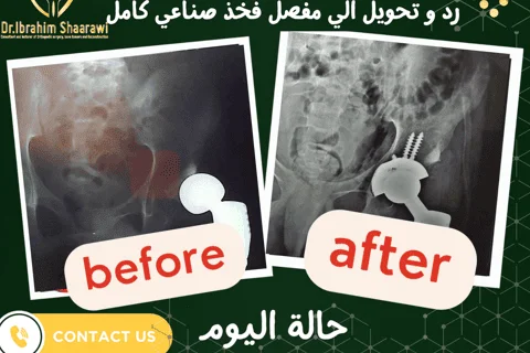 تغيير مفصل الفخذ