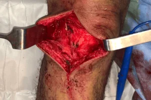 The best orthopedic oncologist in Egypt 2025 Bone cancer treatment