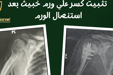 The best orthopedic oncologist in Egypt 2025 Bone secondary schools