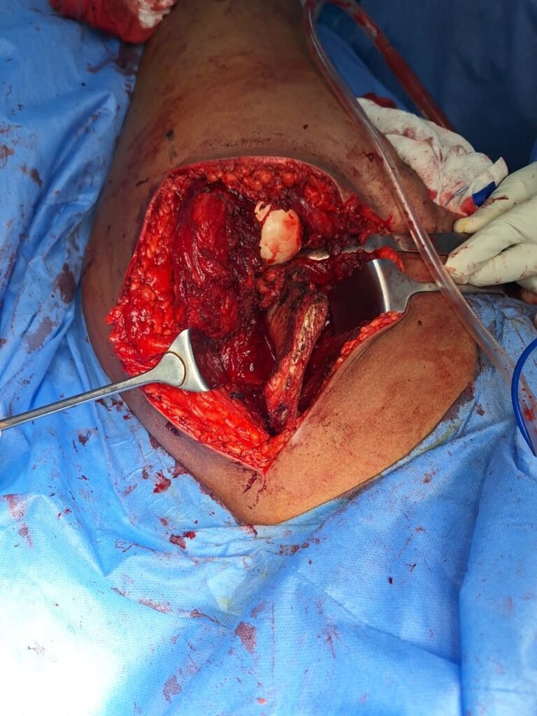 تقوس الركبة و عملية الشق العظمي للركبة عملية الشق العظمي