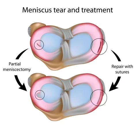 Arthroscopic Meniscus Repair: When Stitching Saves the Meniscus Diagram comparing partial meniscectomy with suture repair of a meniscus tear
