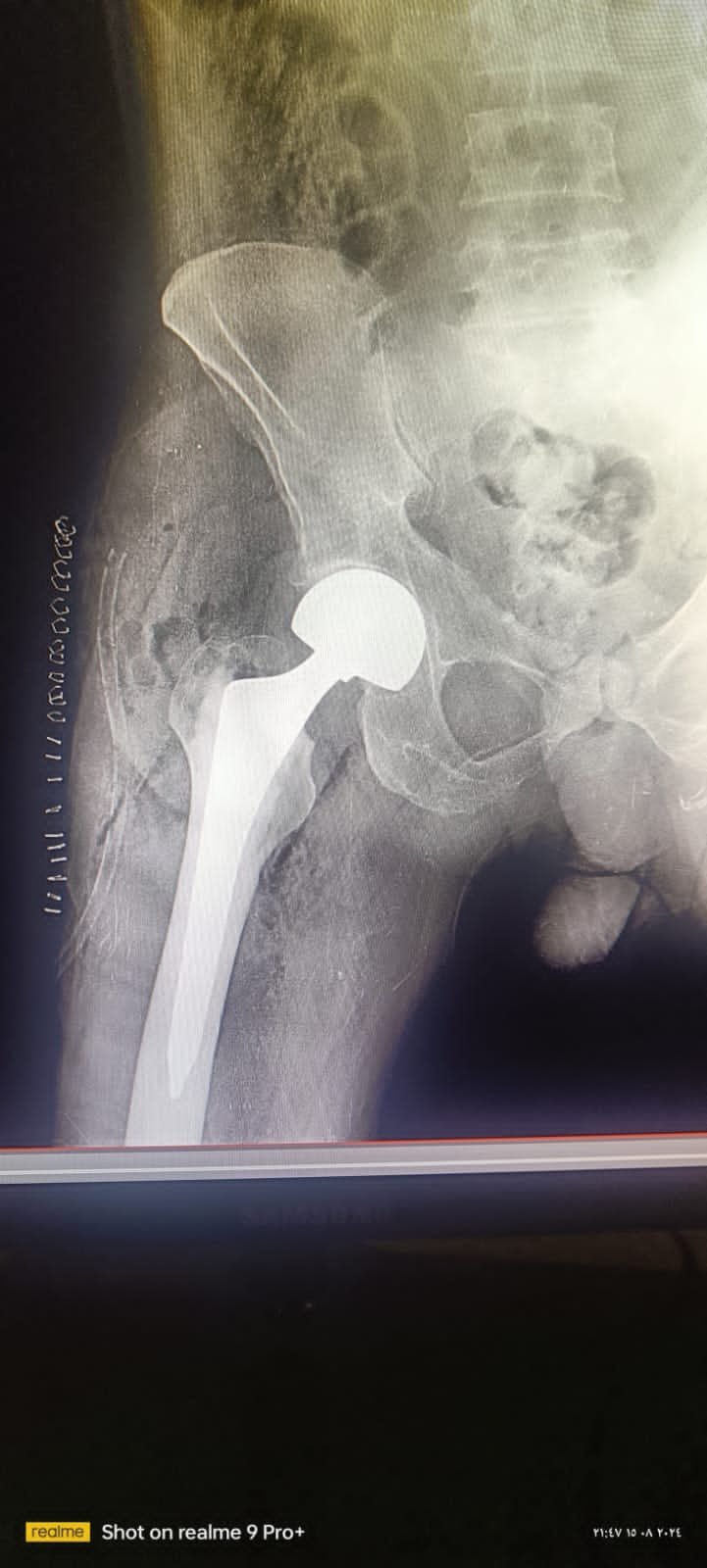 كم سعر عملية تغيير مفصل الحوض الصناعي؟