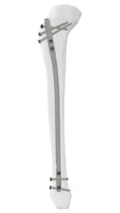 كل ما تحتاج إلى معرفته عن المسمار النخاعي عملية المسمار النخاعي