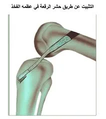 افضل دكتور رباط صليبي في القاهرة افضل دكتور رباط صليبي في القاهرة
