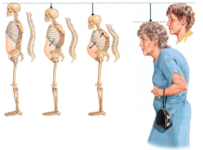Illustration of osteoporosis progression with vertebral fractures and stooped posture in older age