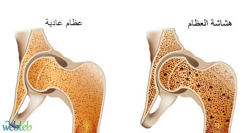 اعراض هشاشة العظام عند النساء هل هشاشة العظام تسبب ألم