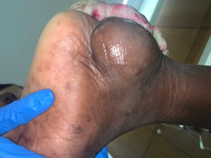 شكل ورم السرطاني في الرجل
