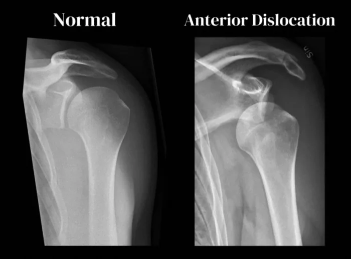 خلع الكتف وعلاجه: الأعراض والأسباب ورد الكتف المخلوع وعلاج خلع الكتف بالصور اشعة خلع الكتف