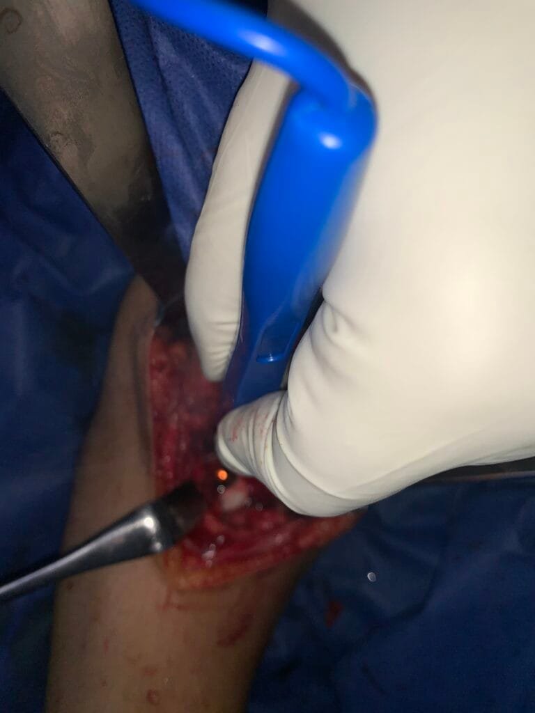 الكيس العظمي: كل ما تحتاج معرفته الكيس العظمي: كل ما تحتاج معرفته