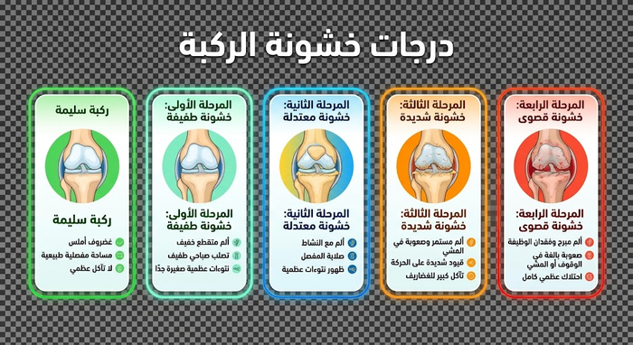 Knee Osteoarthritis Medication Guide