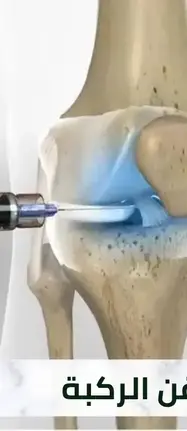 علاج خشونة الركبة بدون جراحة