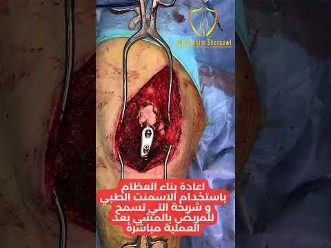 عملية كحت ممتد لورم خلايا عملاقة في الفخذ واعادة بناء باستخدام الاسمنت الطبي والمسامير 