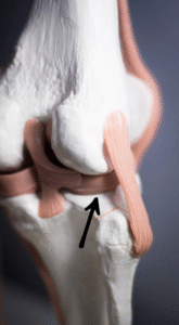 هل يلتئم تمزق الغضروف الهلالي