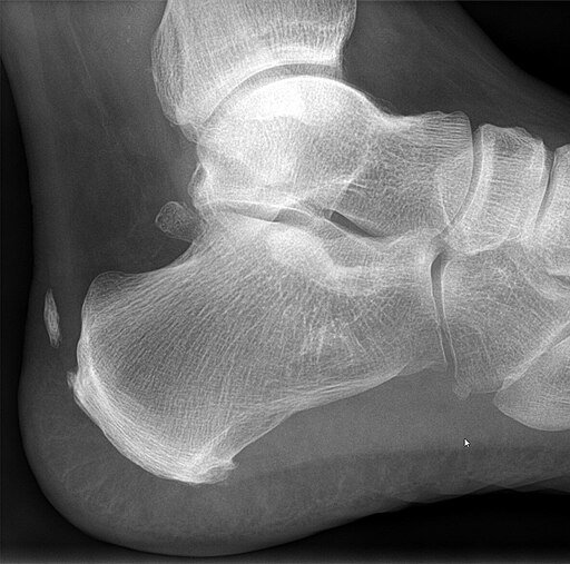 التهاب وتر اكيلس: الأسباب، الأعراض، وأحدث طرق العلاج شكل التهاب وتر اكيليس في الاشعة