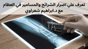 أضرار الشرائح والمسامير