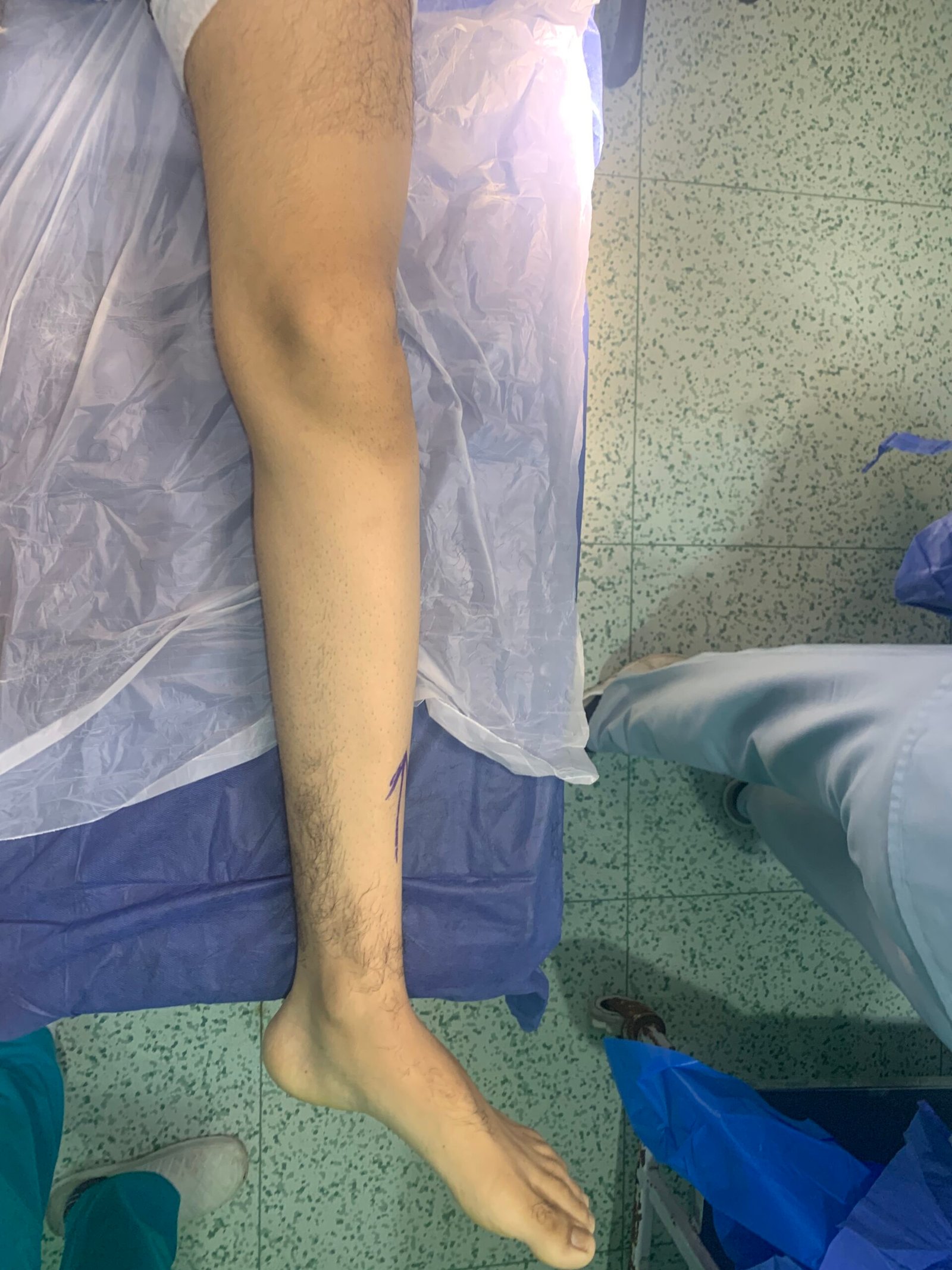 Preoperative marking and draping of the affected limb