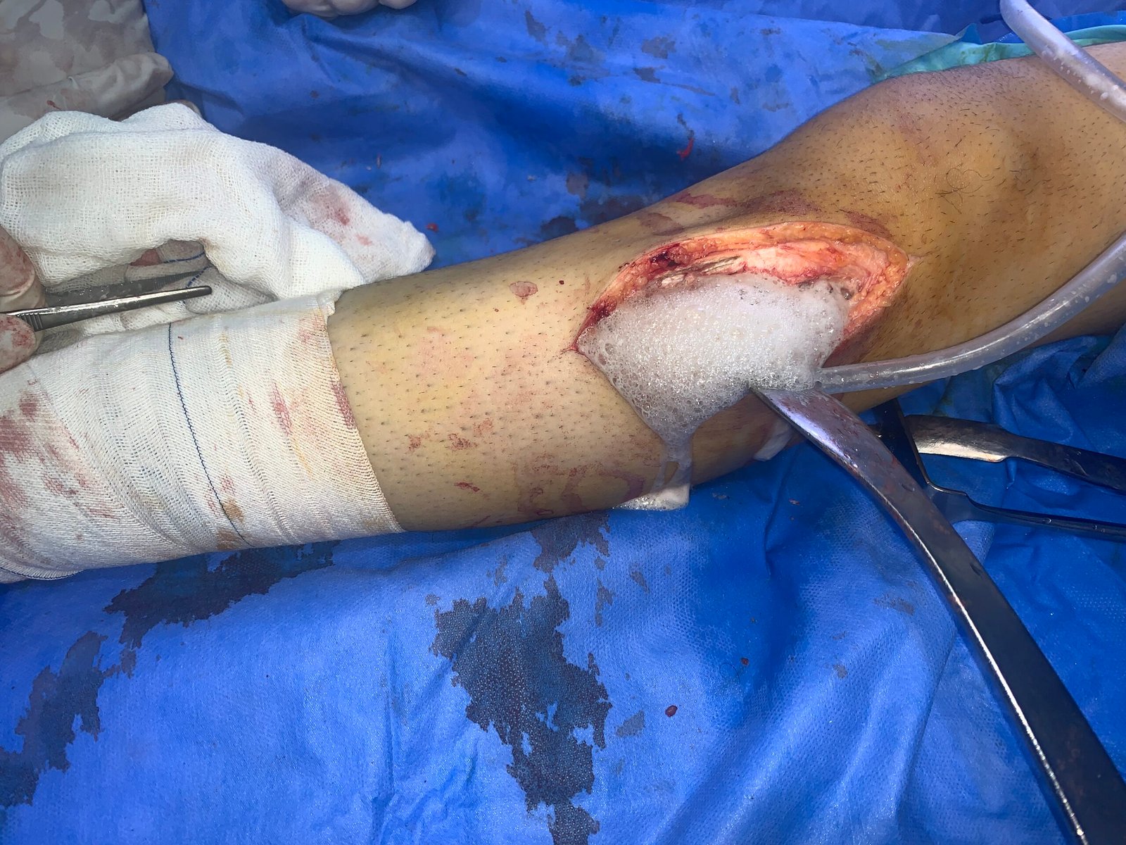 Application of adjuvant treatment inside the cavity