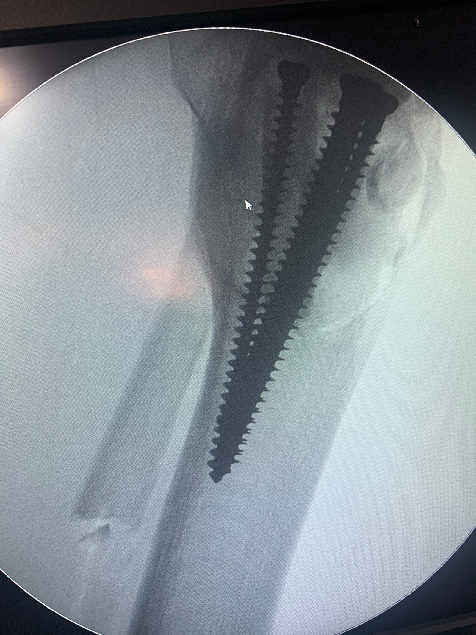 Final intraoperative radiograph confirming reconstruction