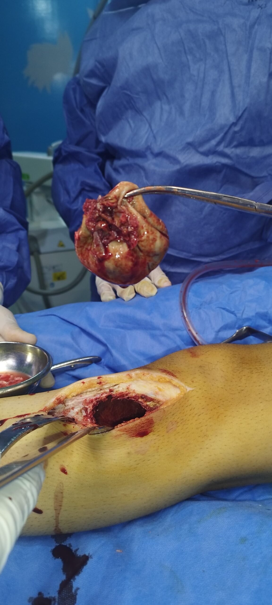 Gross specimen of the excised Giant Cell Tumor