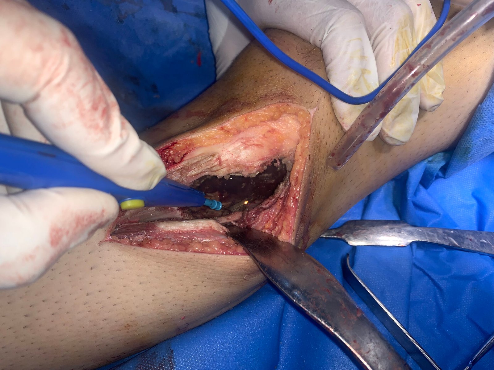 Extended curettage using high-speed tools