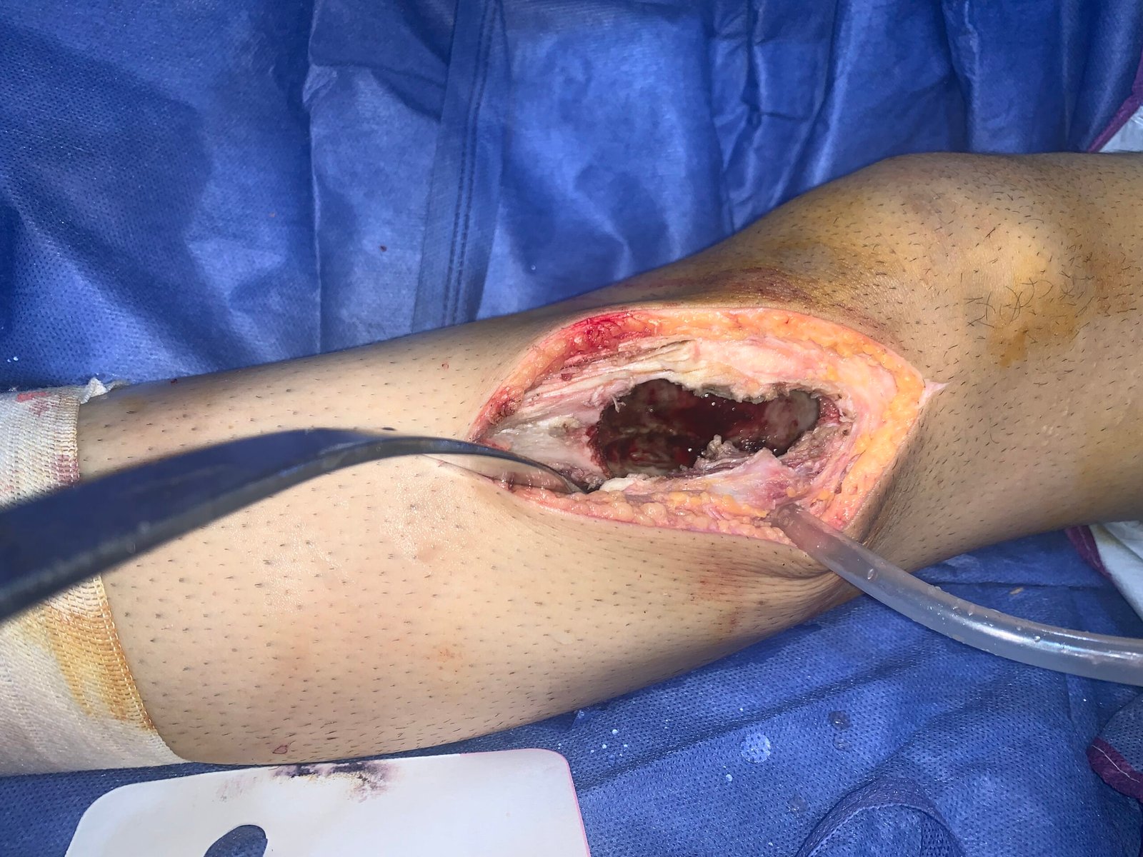 Intraoperative view of the bone cavity post-tumor removal