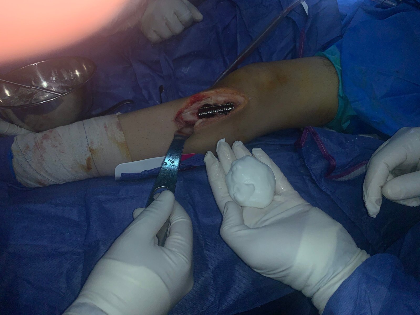 Preparing to fill the bone defect