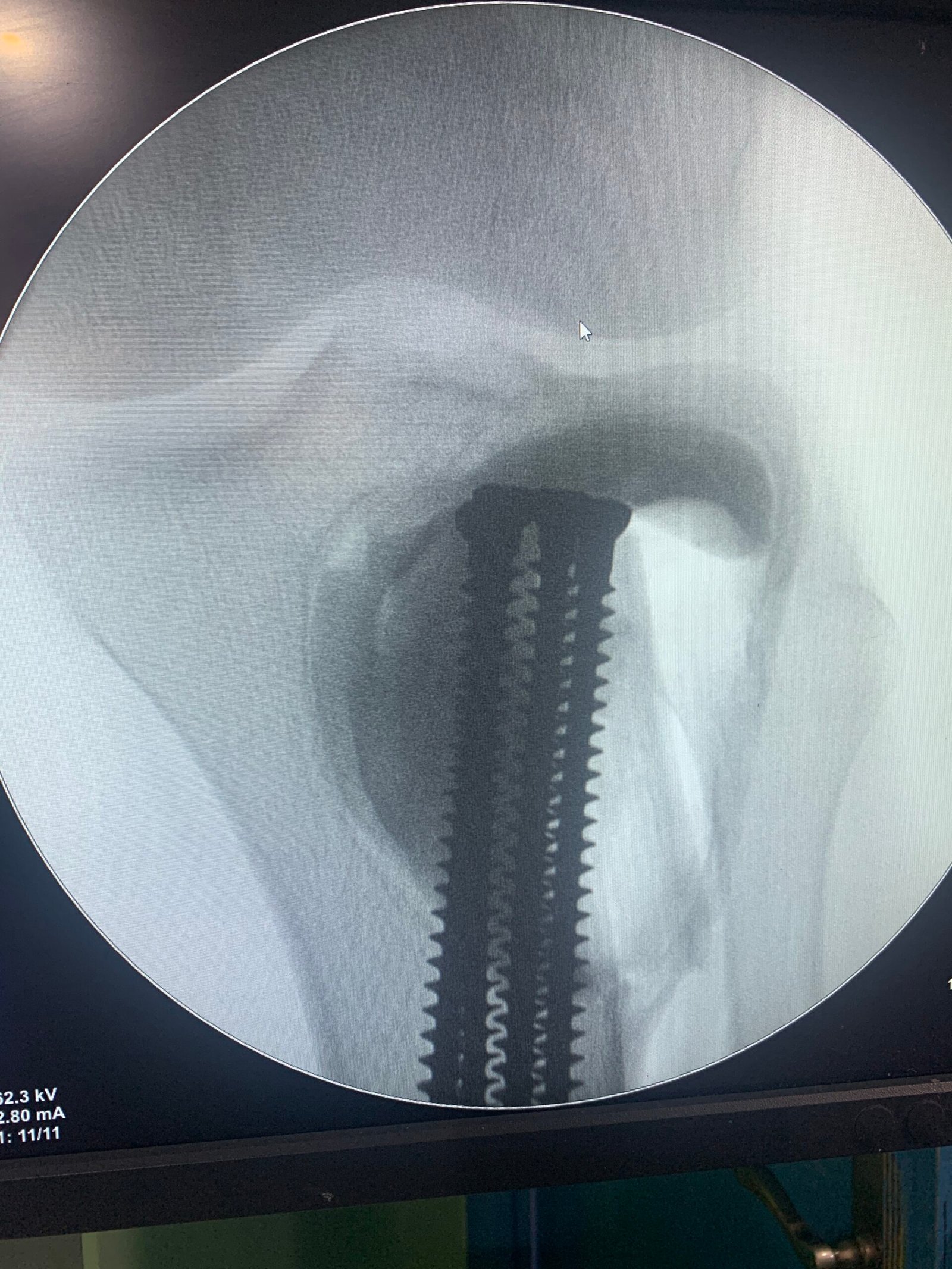 Placement of internal fixation hardware