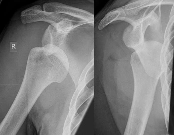 X-ray of a dislocated shoulder before and after reduction, showing the humeral head out of the socket and then back in place