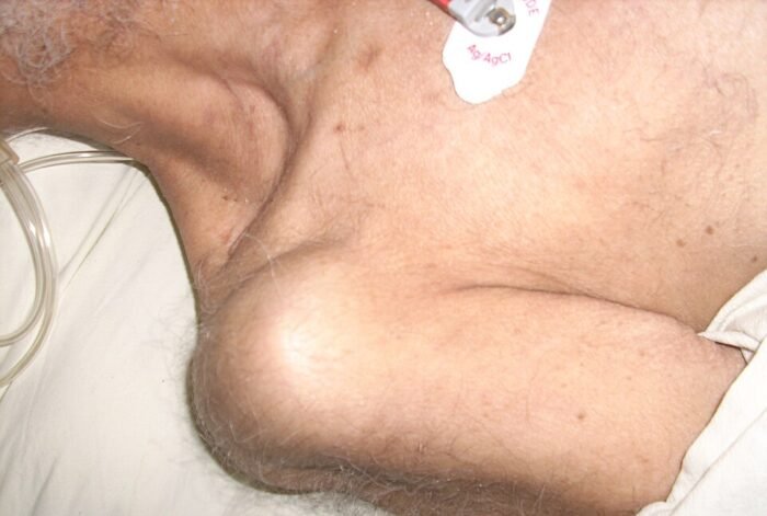 Appearance of a dislocated shoulder: loss of the normal rounded shoulder contour