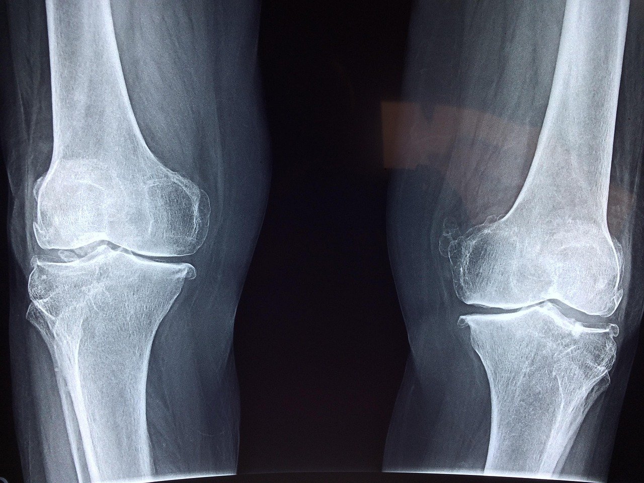 X-ray of the knee joint; plain X-rays do not show the meniscus but rule out fractures and arthritis