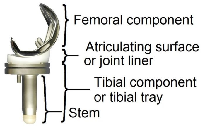 Knee replacement components: femoral component, liner and tibial tray