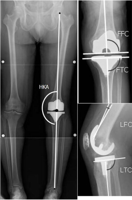 Alternatives to Knee Replacement: Injections, Osteotomy and Partial Knee Long-leg X-ray showing knee alignment and angles
