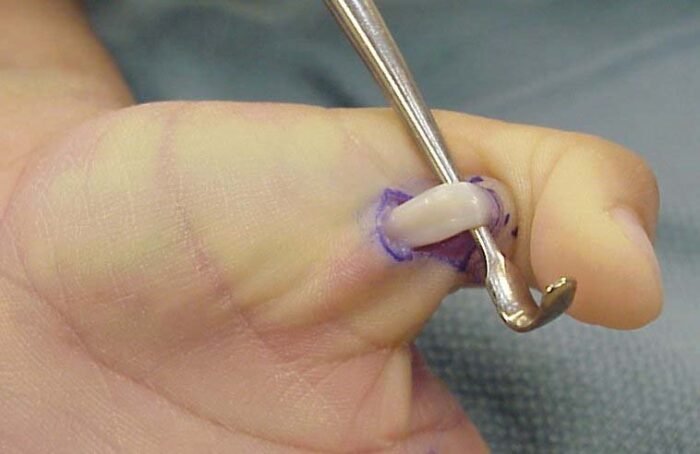Trigger Thumb Release Cost in Egypt (2026): Procedure, Duration and Recovery Release of the A1 pulley in trigger thumb or trigger finger surgery