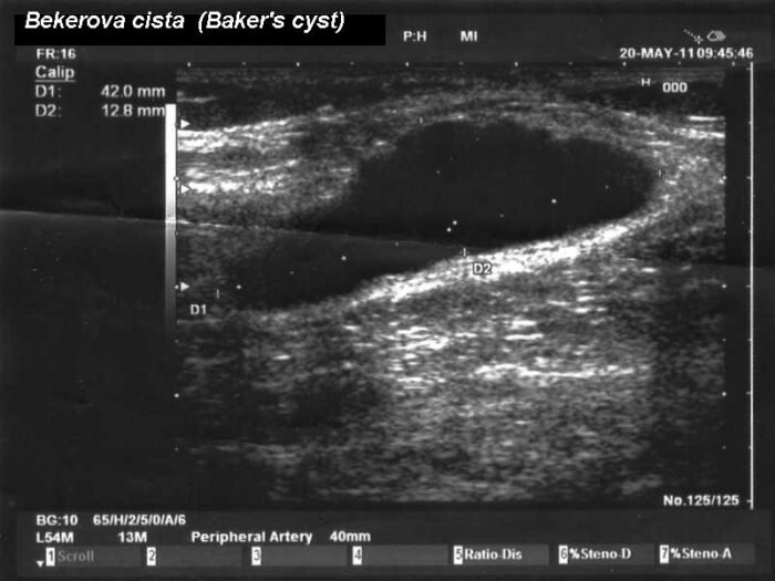 Baker's Cyst and Knee Ganglion Cysts: Causes, Symptoms, Treatment and When It Is Serious Ultrasound showing a fluid-filled Baker's cyst behind the knee