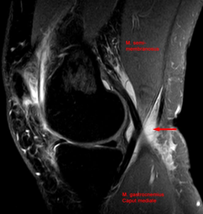 Baker's Cyst and Knee Ganglion Cysts: Causes, Symptoms, Treatment and When It Is Serious Sagittal MRI of the knee showing a Baker's cyst behind the joint