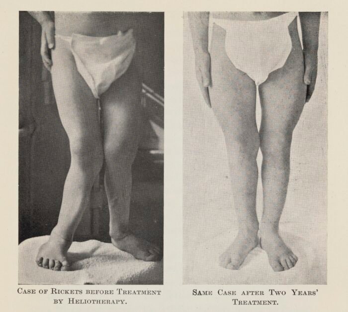 Child with rickets before and after treatment showing improvement in bowed legs