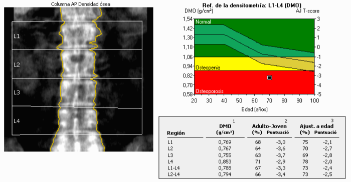 Bone Density Test (DEXA Scan): Normal Range, T-score, Z-score and When to Have One DEXA report of the lumbar spine with T-scores in the osteoporosis range