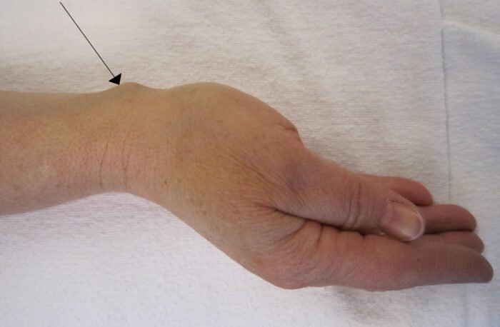 Ganglion cyst on the back of the wrist