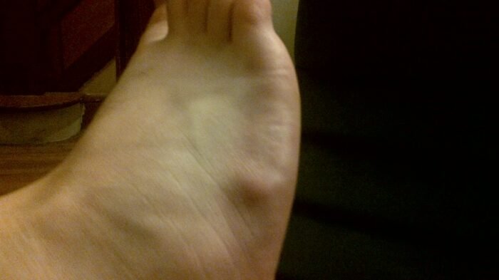 Ganglion cyst on the top of the foot