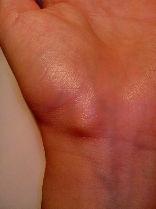 Ganglion cyst on the palm side of the left wrist near the radial artery