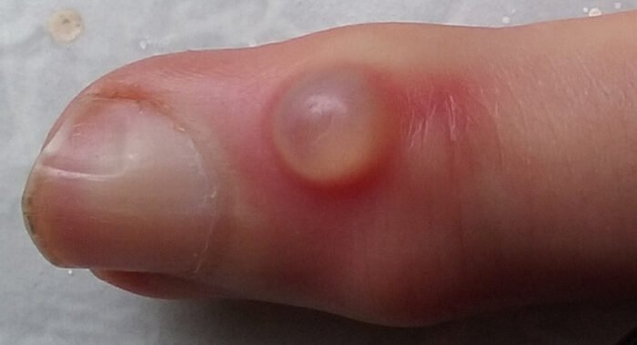 Mucous cyst at the end joint of the index finger