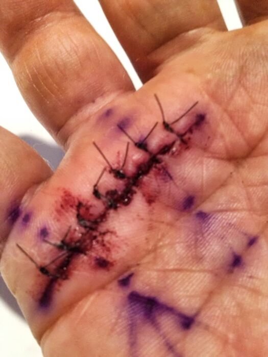 Healing incision after trigger finger release surgery