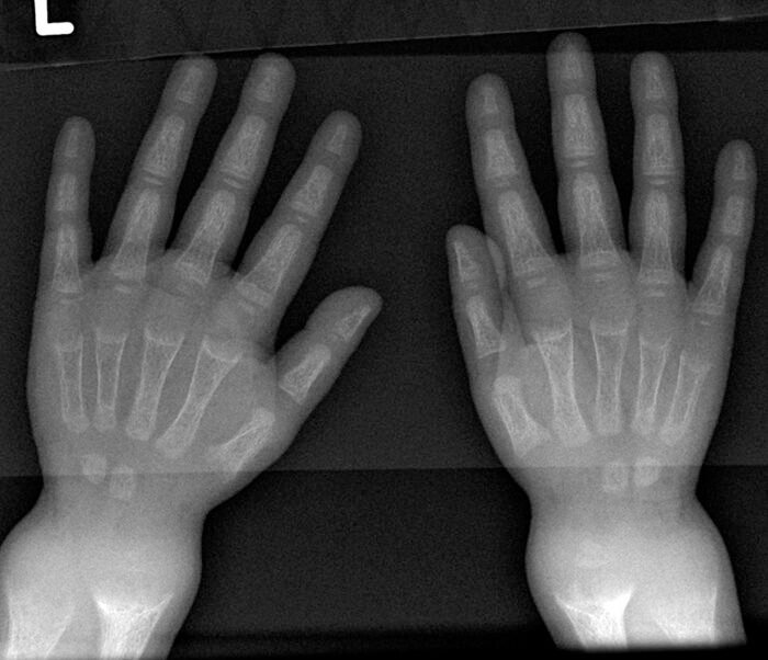 X-ray of a child's hands and wrists with rickets showing widened growth plates