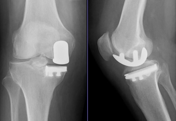 X-ray of a medial partial (unicompartmental) knee replacement