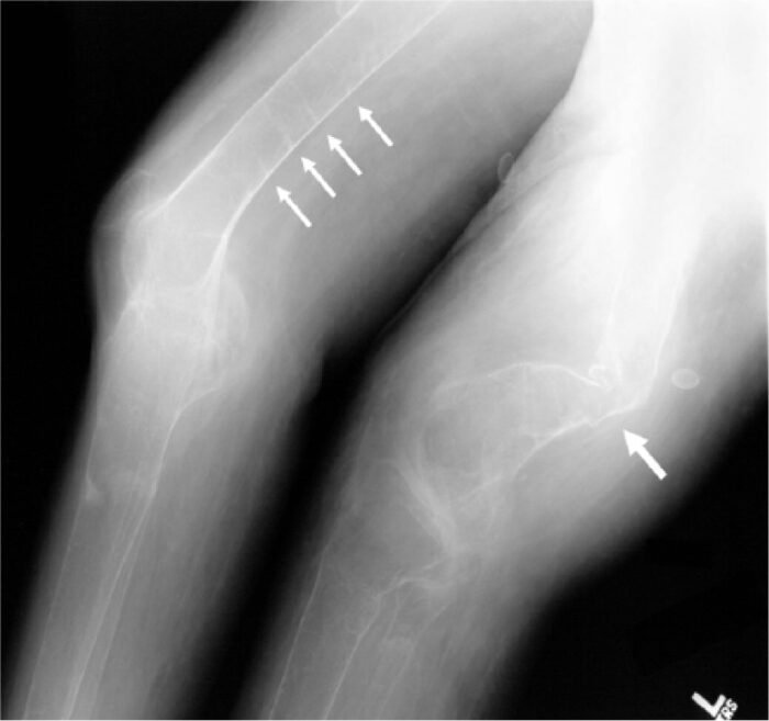 X-ray of the distal femurs showing Looser zones (pseudofractures) in osteomalacia