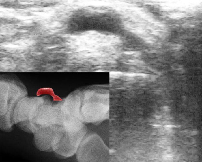 Ultrasound image of a fluid-filled ganglion cyst over the wrist bones