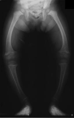 X-ray of a child's legs showing bowing caused by rickets